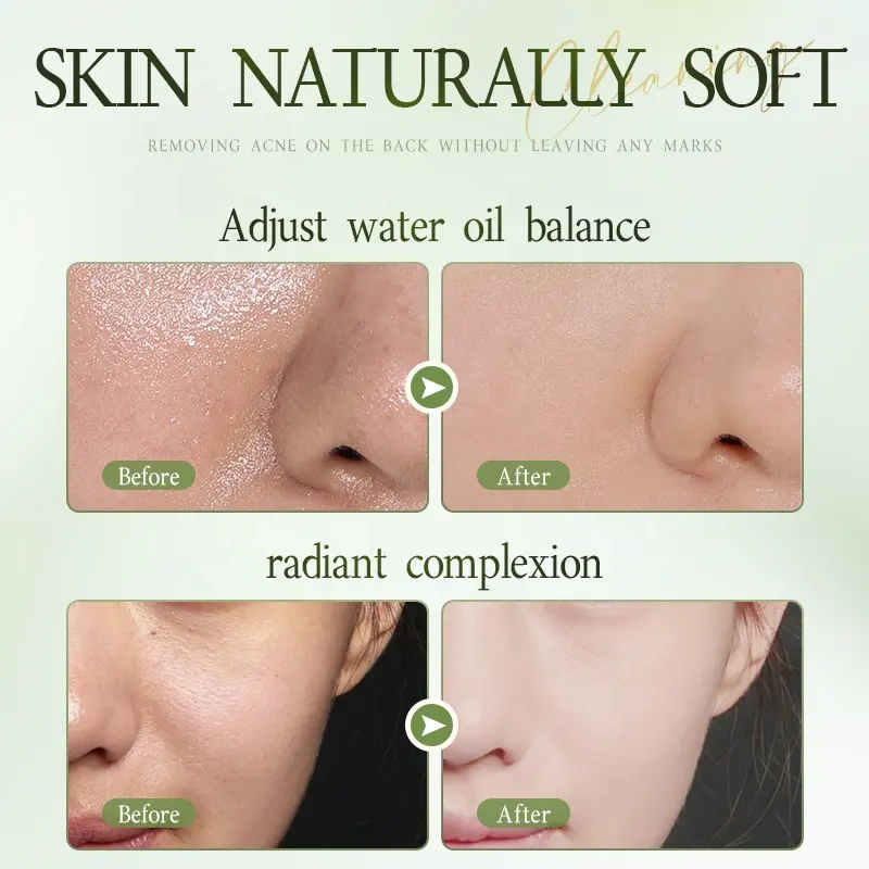 OEM Tea Tree Oil Control Soothing Essence Water Moisturizing Brightening Improve Dullness Lotion