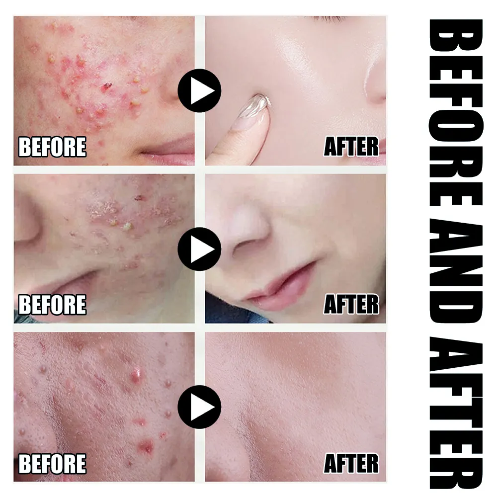 Private Label 2% Salicylic Acid Acne Serum Pimple Remover Natural Oil Control & Barrier Repair Essence Anti-Blemish Treatment