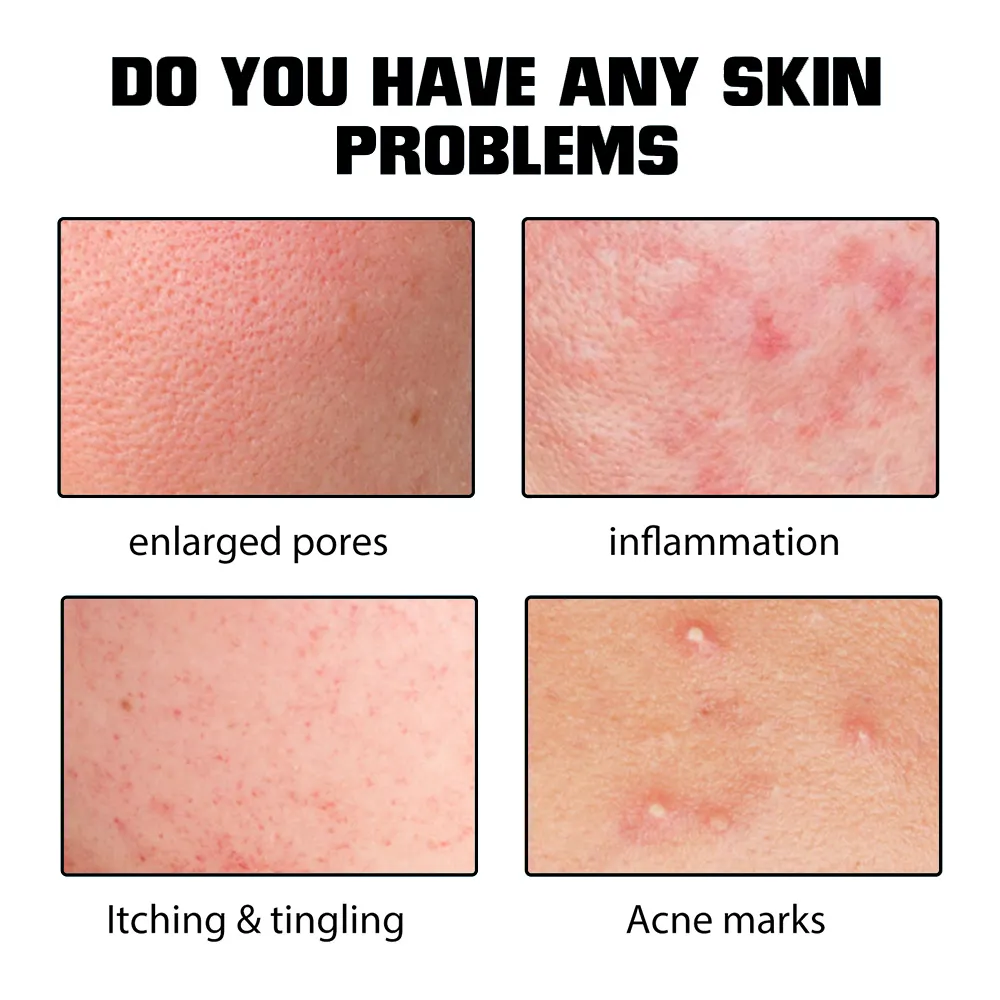 Private Label 2% Salicylic Acid Acne Serum Pimple Remover Natural Oil Control & Barrier Repair Essence Anti-Blemish Treatment