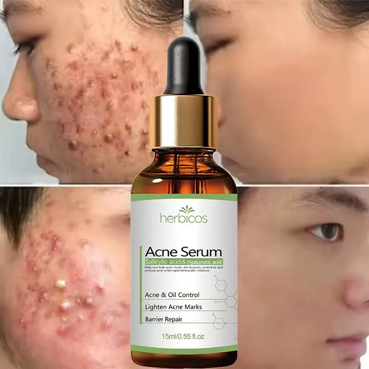 2% Salicylic Acid Anti-Acne Serum BHA Niacinamide Face Treatment Scar Removal Fade Acne Marks Soothe Redness Private Label OEM