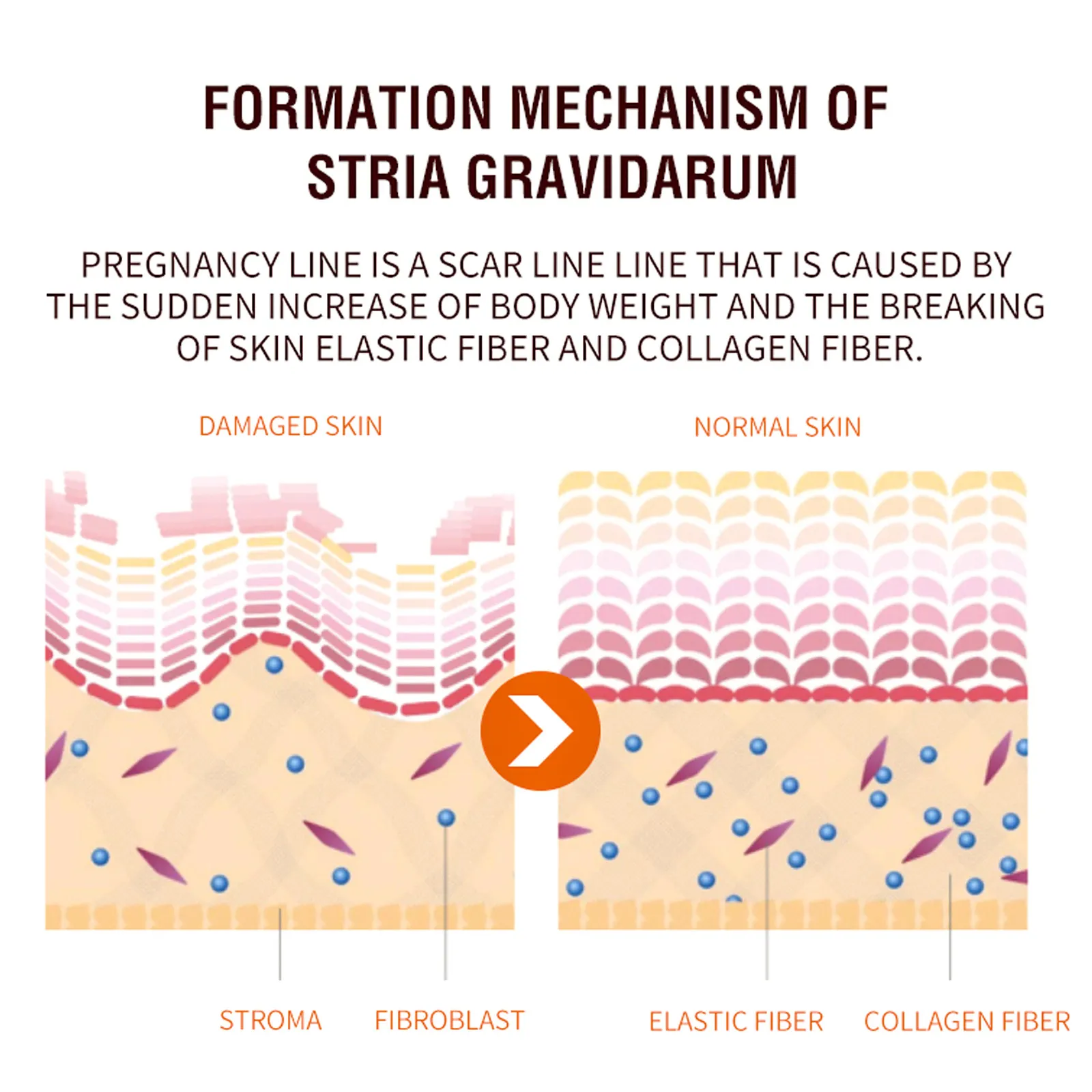 OEM Tummy Leg Facial Scar Cream Pimples Stretch Marks Remove Cream Strong Effective Acne Scar Removal Cream Smagliature