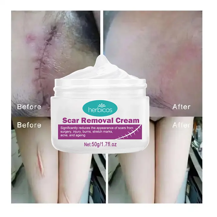 Herbicos Acne Scar Removal Creamstretch Marks Repairing Cream Body Lotion Pregnant Pregnancy Women Day Adults Hyaluronic Acid