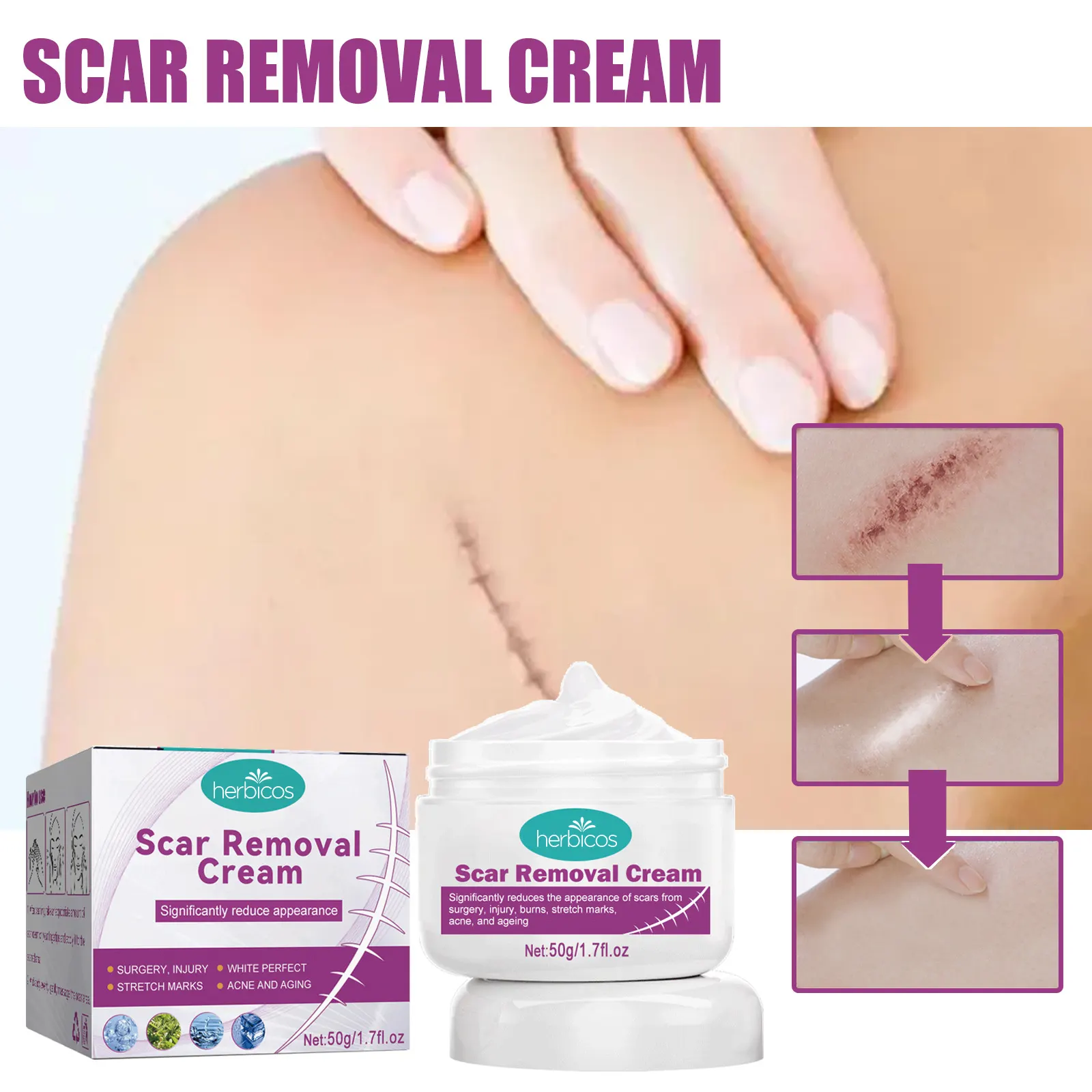Herbicos Acne Scar Removal Creamstretch Marks Repairing Cream Body Lotion Pregnant Pregnancy Women Day Adults Hyaluronic Acid