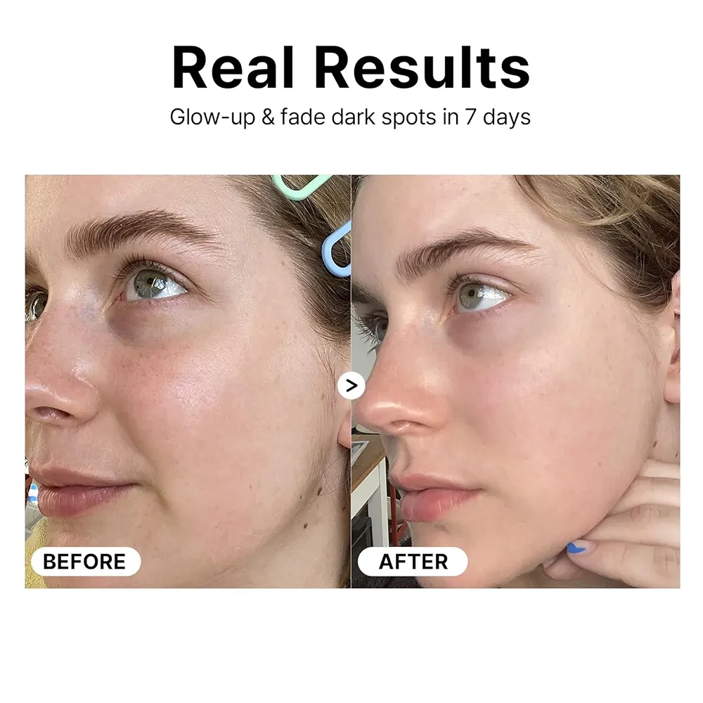 Vitamin C Kojic Acid Exfoliator Serum with Squalane Hyaluronic Acid & Vitamin E-Anti-Wrinkle 30ml Kojic Acid Oil