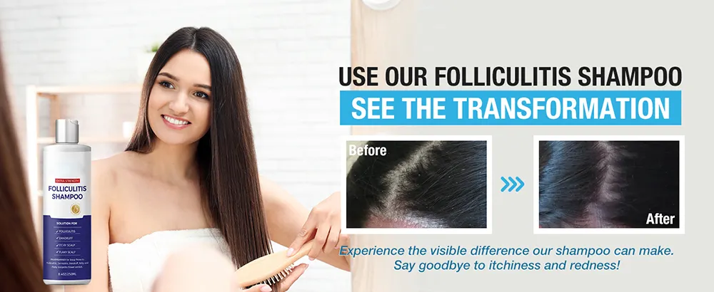 Moisturizing and Nourishing Anti-Dandruff Shampoo for Itchy Dry Scalp-Treats Folliculitis Seborrheic Dermatitis Psoriasis